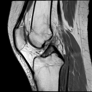 MRI-Bild eines Knies.
