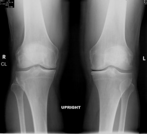Röntgenbild eines Knies.